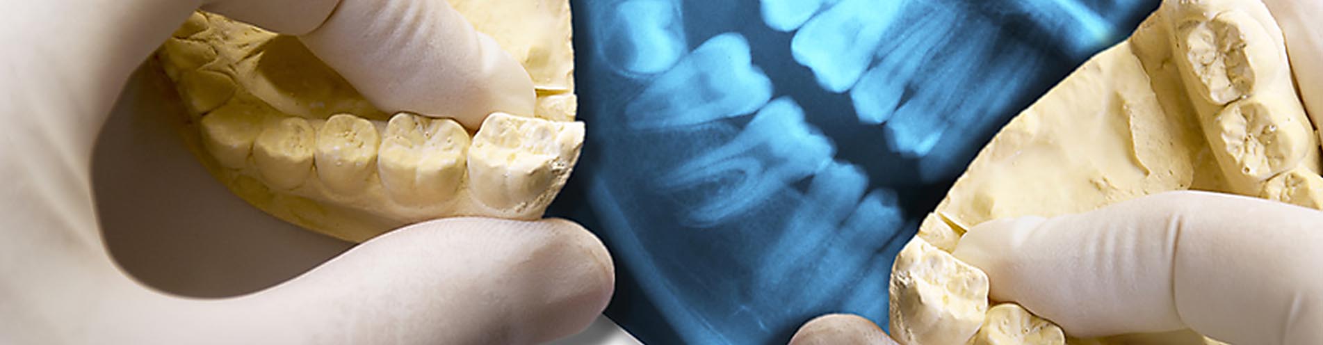 Wir sind spezialisiert auf Zahnimplantate. Aber auch Probleme an Weisheitszähnen behandeln wir seit Jahrzehnten sehr erfolgreich.